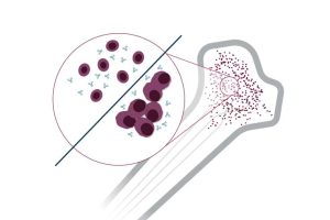Mieloma M ltiplo International Myeloma Foundation Latin America mieloma-m-ltiplo-international-myeloma-foundation-latin-america